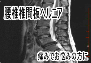 腰椎椎間板ヘルニアと坐骨神経痛の関係
